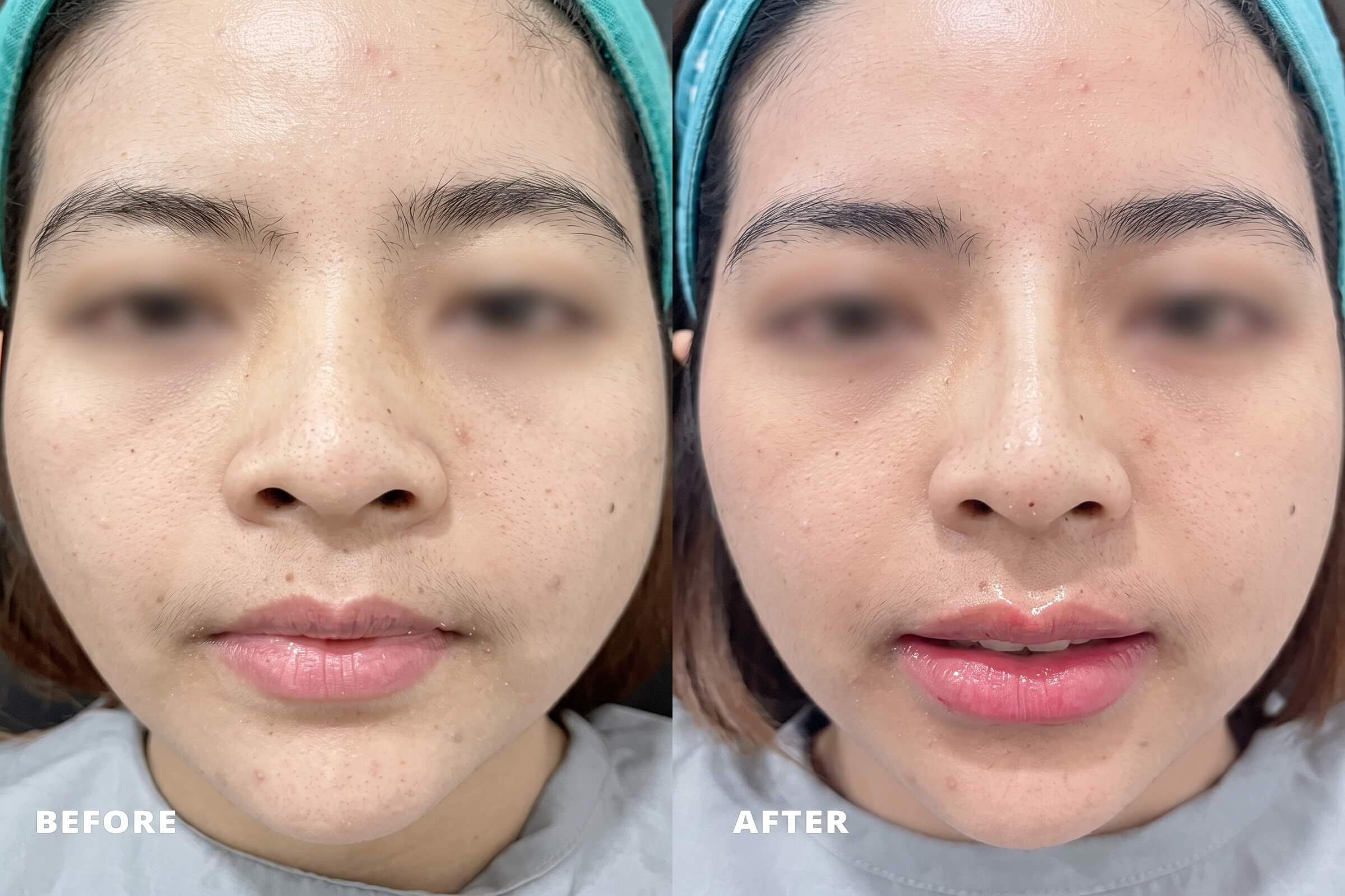 Prosedur Tarik Benang Hidung dan Filler Mahayu Aesthetic Clinic